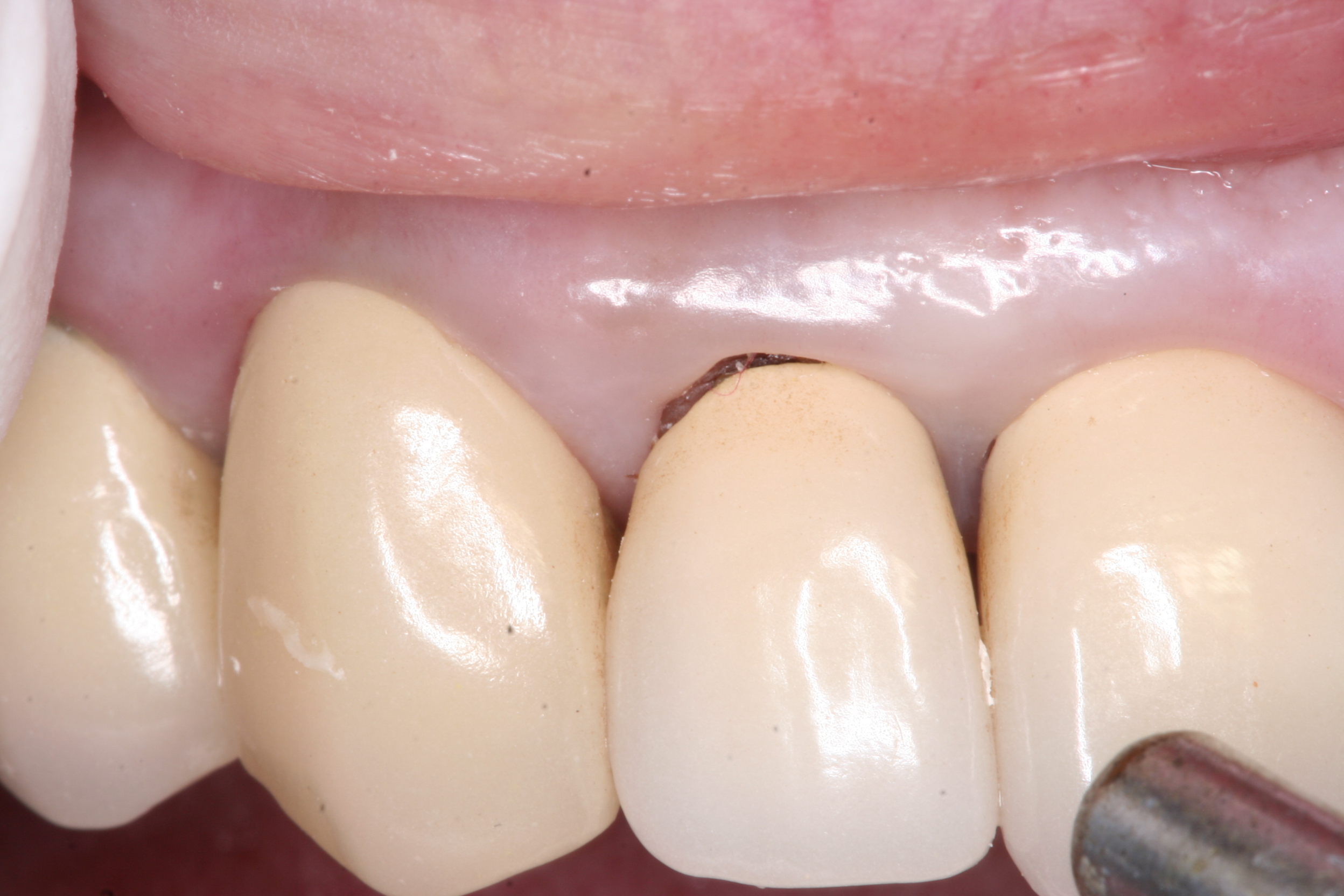 Index of /images/concerns/decay under crown